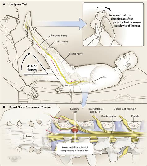 sciatica compression test|diagnosing sciatic spine.